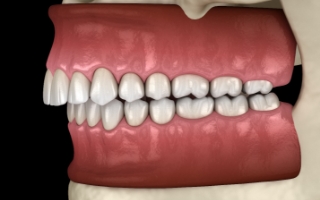 Illustration of crowded teeth