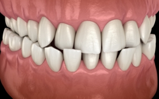 Illustration of crowded teeth