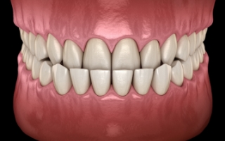 Illustration of crowded teeth