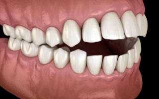 Illustration of crowded teeth