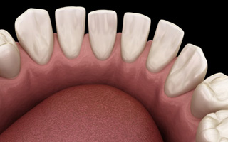 Illustration of teeth with gaps