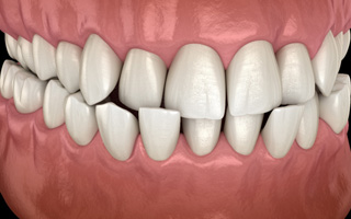 Illustration of crossbite