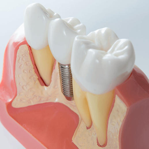 Tooth mold displaying how dental implants work in Arlington