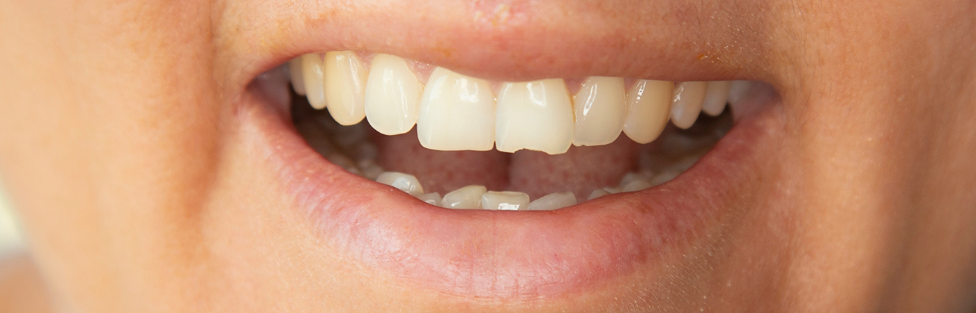 Close-up of chipped teeth in need of restorative dentistry in Arlington