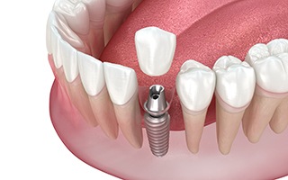 Illustration of a single dental implant