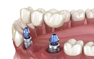 Illustration of an implant bridge