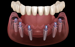 Illustration of an implant denture