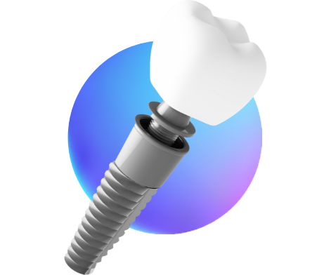 Illustration of dental implant with crown
