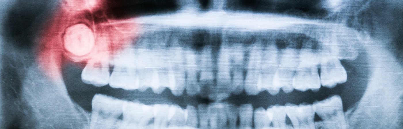 X-ray showing an impacted wisdom tooth